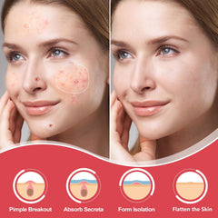 AcneGo hydrocolloid patches on skin show strong adhesion and water-resistant protection for overnight use.