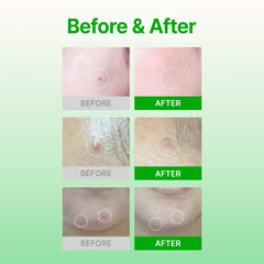 Acropass Trouble Care patch placed on a pimple demonstrates early-stage acne targeting.