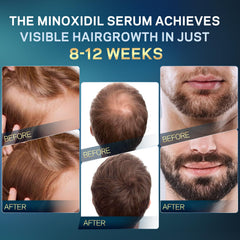AMOADO dropper applying minoxidil on scalp for precise, easy usage.