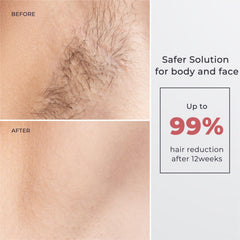 Aopvui laser hair removal device side handheld shot for precise body coverage