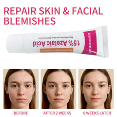 Azelaic Acid Facial Cream packaging shown for premium skincare
