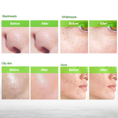 Blooskim Blackhead Remover Mask in drying stage demonstrates peel-off action.