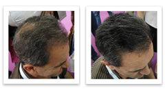 Caboki before-after thinning hair density shows improved fullness