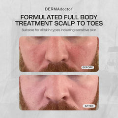 DERMAdoctor Seborrheic Dermatitis Face Wash rich lather cleanses face, body, and scalp with ease.