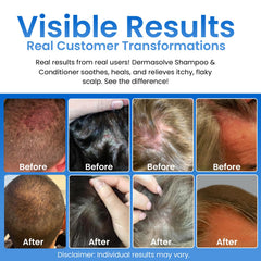Dermasolve shampoo foamy-lather demonstrating gentle cleansing for irritated scalp