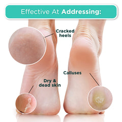 DERMORA foot peel mask packaging shot emphasizing universal fit up to size 11.