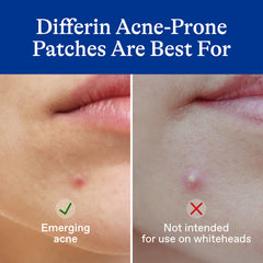 Differin patch used day and night under makeup for discreet protection.