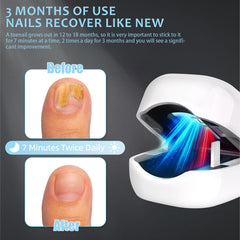 easheal nail fungus laser device during a seven-minute treatment session