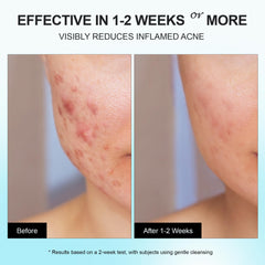 Enaskin Naturals acne-spot treatment on skin demonstrates fast absorption without pilling.