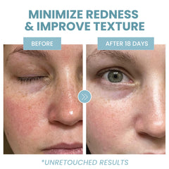 Eva Naturals Azelaic Acid Serum ingredients niacinamide for balanced tone.