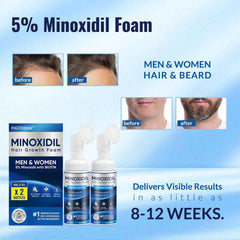 FIGTORUS Minoxidil Foam texture on scalp for improved absorption.