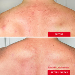 First Aid Beauty with glycerin hydrates and soothes sensitive skin during treatment