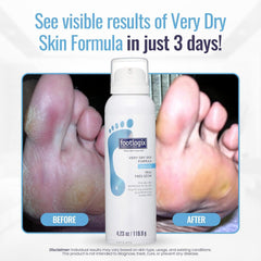 Footlogix 03 application shot demonstrating easy topical use for dry feet