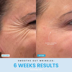 Forchics LiftLab blue-mode on skin for texture clarity and pores refinement.