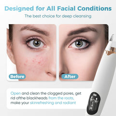 Gacavks blackhead removal probe closeup highlights precision tip for targeted blackhead extraction