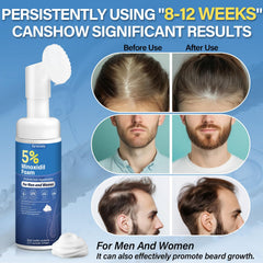 Greoay 5 Percent Minoxidil Foam bottle closeup highlights smooth texture for easy, mess-free use