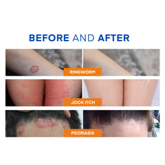 Hermon Ringworm Soap sulfur-thermal-water-foam provides deep cleansing action.