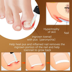 Iaolose paronychia nursing oil tube closeup emphasizes natural actives.