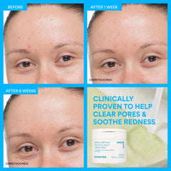 Innisfree retinol toner pad left on for 10 minutes demonstrates calm and hydration.