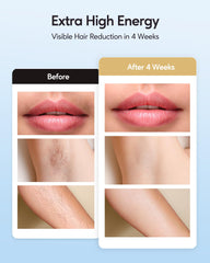 INNZA IPL device auto mode for large-area treatments.
