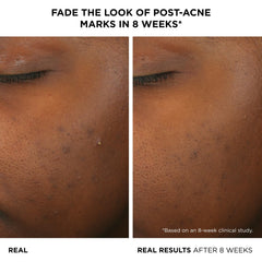 IT Cosmetics acne serum application pump demonstrates easy twice-daily routine