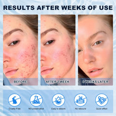 Marianp Azelaic Acid 10% Cream pigmentation-before-after hints at more even tone.