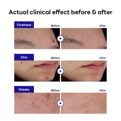 Mediheal Derma Clear patch on skin demonstrates soothing madecassoside and niacinamide for irritation.