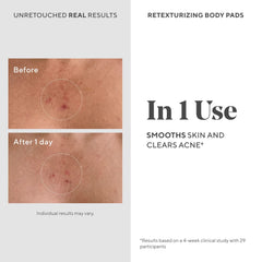 Murad Retexturizing Body Pad applied to forearm for acne-prone skin