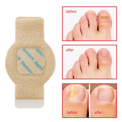 Nail Patches damaged-nails-repair emphasizes potential improvement in discoloration and texture.