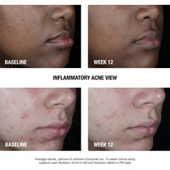 Application scene of Neutrogena AM Treatment being applied to skin for quick action.