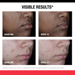 Neutrogena Stubborn Marks PM Treatment night-time routine image suggests pairing with AM treatment.