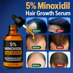 Nincrane minoxidil applied to scalp illustrating targeted hair regrowth.