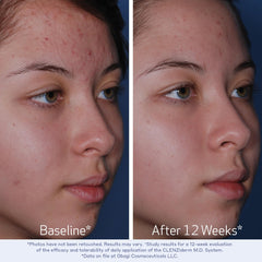 Obagi CLENZIderm treatment-lotion-bpo targets blemishes with 5% benzoyl peroxide