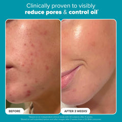 Paula's Choice 2% BHA application shot for daily gentle exfoliation.