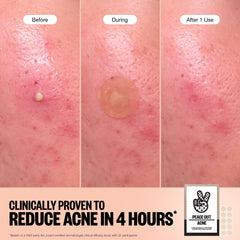 PEACE OUT Acne Healing Dots on facial blemish for overnight treatment.