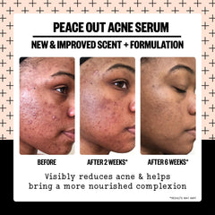 Peace Out Acne Serum spot-application during breakouts on clean skin