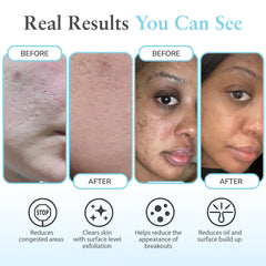 Perfect Image Salicylic 10% Gel Peel texture close-up demonstrates gentle exfoliation for smoother skin.