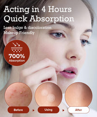 Pimple Lab hydrocolloid absorption technology patch shows rapid fluid uptake for healing.