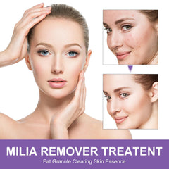 QKDBLWX Milia Remover face-area application—even coverage on pores and milia