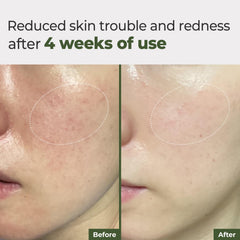 Rbfy Daily Ampoule Pad Chamomile and Houttuynia shot—gentle redness relief.