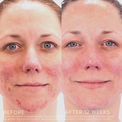 RODAN + FIELDS Unblemish precision pump image highlighting controlled dispense for targeted treatment.