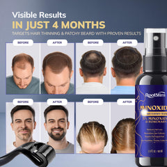 RootStim 0.25mm derma roller close-up for gentle scalp prep and product contact.