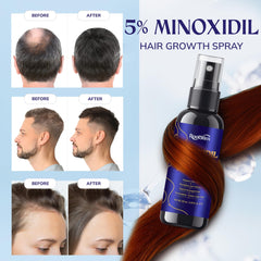 RootStim minoxidil scalp treatment applied to thinning areas for targeted support.