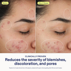 Skinfix 2% BHA Cleanser with green tea and zinc—soothing inflammation for clearer skin.