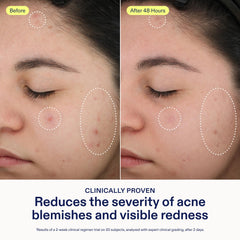 Skinfix 2% BHA Spot Treatment application dot demonstrates precise spot use on blemishes.