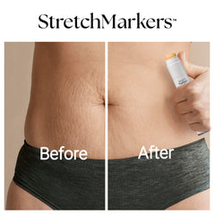 StretchMarkers Therapy ingredients retinol and hyaluronic acid microspheres for deep hydration.