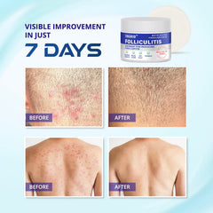 TAGRID Folliculitis Cream packaging emphasizes natural organic ingredients.
