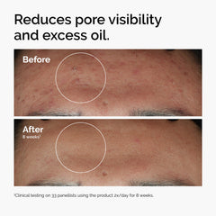 The Ordinary Niacinamide 10% + Zinc 1% dropper in use for daily application.