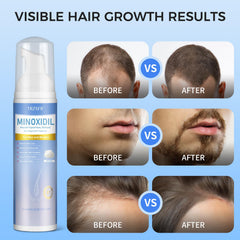 Trzsfr minoxidil foam closeup texture indicating fast absorption