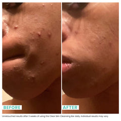 Urban Skin Rx Clear Skin Bar mask application focusing on blemish-prone skin.